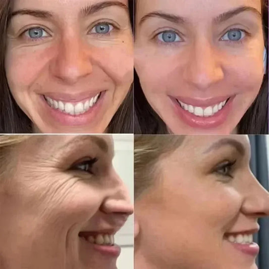 Wrinkle Removal Facial Tightening